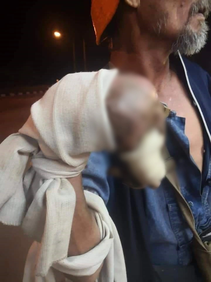 คุณลุงมือขวาใหญ่โตผิดปกติ สุดเจ็บป่วยทรมาน ไร้เงินรักษาร่างกาย