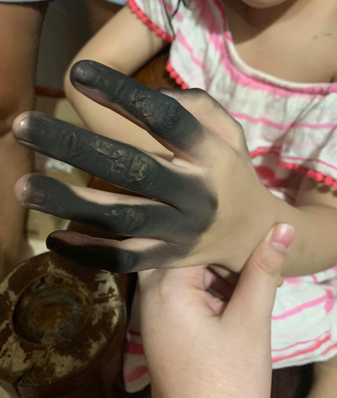 แม่เผยภาพ ลูกน้อยวัย 7 ขวบ เจอปลั๊กบึ้มใส่มือ หลังเสียบปลั๊กพ่วง