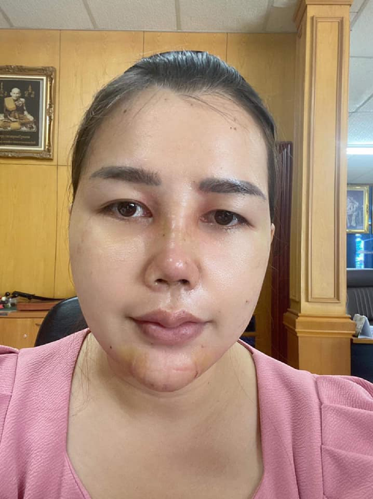 เจ้าของคลินิก เผยภาพล่าสุด เมียหลวงบุกงานแต่ง ได้ตัดไหมแล้ว หลังเข้าโครงการทำสวยให้ผัวเสียดาย ครบ 14 วัน บอกเลยว่าสวยเป๊ะทุกองศามาก ๆ เปลี่ยนไปเป็นคนละคนเลยทีเดียว