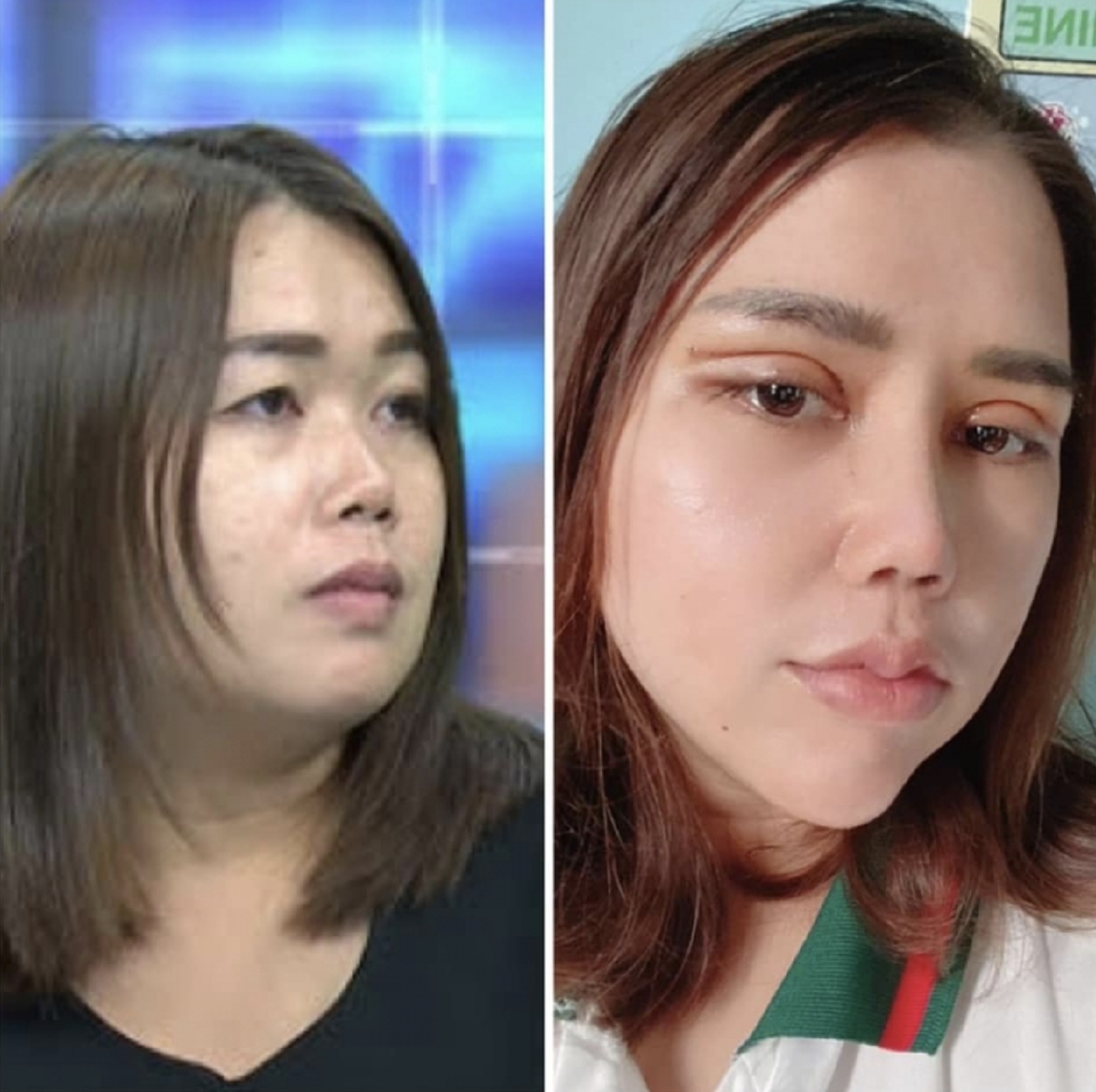 เจ้าของคลินิก เผยภาพล่าสุด เมียหลวงบุกงานแต่ง ได้ตัดไหมแล้ว หลังเข้าโครงการทำสวยให้ผัวเสียดาย ครบ 14 วัน บอกเลยว่าสวยเป๊ะทุกองศามาก ๆ เปลี่ยนไปเป็นคนละคนเลยทีเดียว