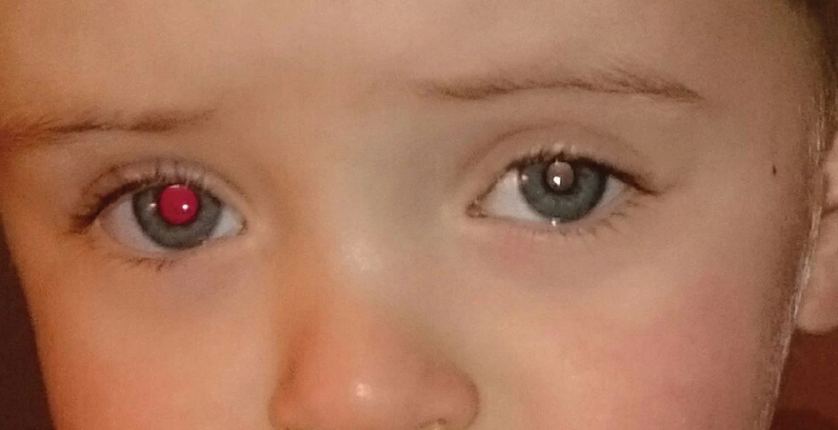 โรคร้ายที่เกี่ยวข้องกับ Red Reflex ผิดปกติ -  มะเร็งจอตา (Retinoblastoma): พบมากในเด็กต่ำกว่า 5 ปี หากตรวจเร็วรักษาได้ แต่หากช้าอาจต้องควักลูกตา หรือถึงขั้นเสียชีวิต -  ต้อกระจกแต่กำเนิด: รบกวนการพัฒนาการมองเห็น - Leukocoria: ภาวะแสงขาวสะท้อนจากดวงตา อาจเกี่ยวข้องกับเส้นเลือดหรือจอประสาทตาผิดปกติ  วิธีตรวจ Red Reflex ง่าย ๆ ที่บ้าน 1.ปิดไฟในห้องให้สลัว 2.เปิดแฟลชกล้องมือถือ 3.ให้ลูกมองตรงไปที่กล้อง แล้วถ่ายภาพ 4.สังเกตว่า “แสงสะท้อนในตาทั้งสองข้างเป็นสีแดงเท่ากันหรือไม่” หากพบว่าเป็น “สีขาว” หรือ “ไม่เท่ากัน” ควรรีบพาไปพบจักษุแพทย์ทันที  ตรวจเร็ว รักษาได้ โรคตาในเด็กหลายชนิดรักษาได้ หากตรวจพบตั้งแต่เนิ่น ๆ โดยเฉพาะในช่วงอายุ 0–5 ปี ซึ่งเป็นช่วงสำคัญของพัฒนาการการมองเห็น การตรวจ Red Reflex จึงเป็นอีกหนึ่งเครื่องมือง่าย ๆ ที่สามารถ “ช่วยชีวิต” หรือ “ช่วยดวงตา” ของลูกคุณไว้ได้ทันเวลา  บทสรุป อย่ามองข้าม “แสงสีขาวในตา” ที่คุณเห็นในรูปถ่ายธรรมดา มันอาจเป็นสัญญาณที่ช่วยให้คุณตรวจพบโรคตาร้ายแรงได้ก่อนจะสายเกินไป ควรรีบปรึกษาแพทย์ผู้เชี่ยวชาญ หากพบสิ่งผิดปกติแม้เพียงเล็กน้อย เพราะ การมองเห็นของลูกคือสิ่งที่มีค่าที่สุด
