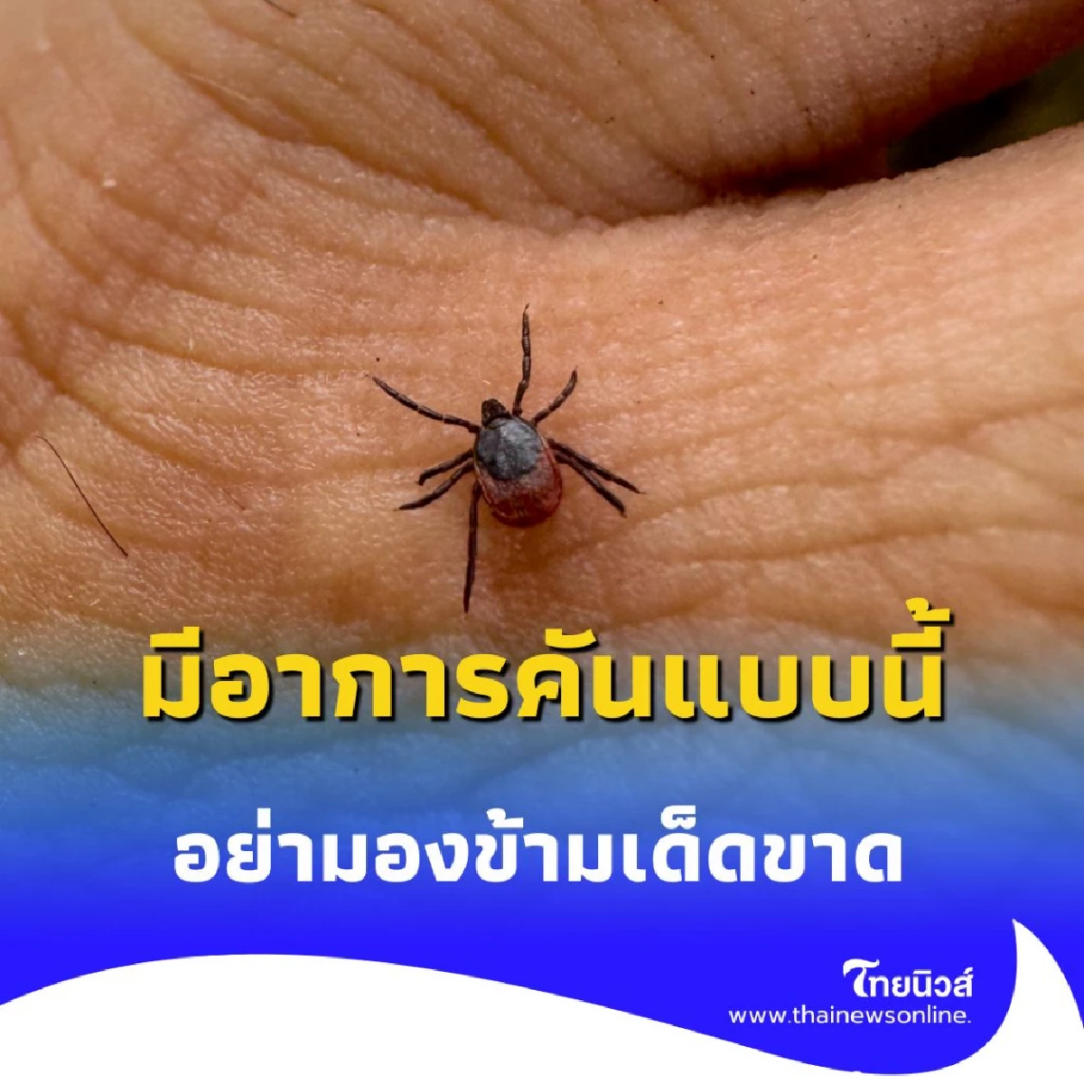 เห็บกัดคน เจ็บแค่ไหน รักษาอย่างไร เปิดอาการที่คุณต้องรู้