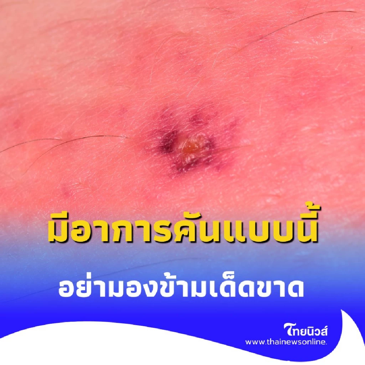 เห็บกัดคน เจ็บแค่ไหน รักษาอย่างไร เปิดอาการที่คุณต้องรู้