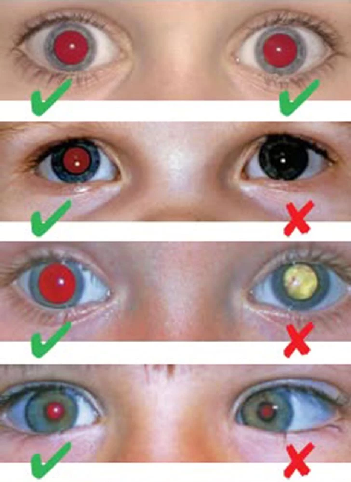 โรคร้ายที่เกี่ยวข้องกับ Red Reflex ผิดปกติ -  มะเร็งจอตา (Retinoblastoma): พบมากในเด็กต่ำกว่า 5 ปี หากตรวจเร็วรักษาได้ แต่หากช้าอาจต้องควักลูกตา หรือถึงขั้นเสียชีวิต -  ต้อกระจกแต่กำเนิด: รบกวนการพัฒนาการมองเห็น - Leukocoria: ภาวะแสงขาวสะท้อนจากดวงตา อาจเกี่ยวข้องกับเส้นเลือดหรือจอประสาทตาผิดปกติ  วิธีตรวจ Red Reflex ง่าย ๆ ที่บ้าน 1.ปิดไฟในห้องให้สลัว 2.เปิดแฟลชกล้องมือถือ 3.ให้ลูกมองตรงไปที่กล้อง แล้วถ่ายภาพ 4.สังเกตว่า “แสงสะท้อนในตาทั้งสองข้างเป็นสีแดงเท่ากันหรือไม่” หากพบว่าเป็น “สีขาว” หรือ “ไม่เท่ากัน” ควรรีบพาไปพบจักษุแพทย์ทันที  ตรวจเร็ว รักษาได้ โรคตาในเด็กหลายชนิดรักษาได้ หากตรวจพบตั้งแต่เนิ่น ๆ โดยเฉพาะในช่วงอายุ 0–5 ปี ซึ่งเป็นช่วงสำคัญของพัฒนาการการมองเห็น การตรวจ Red Reflex จึงเป็นอีกหนึ่งเครื่องมือง่าย ๆ ที่สามารถ “ช่วยชีวิต” หรือ “ช่วยดวงตา” ของลูกคุณไว้ได้ทันเวลา  บทสรุป อย่ามองข้าม “แสงสีขาวในตา” ที่คุณเห็นในรูปถ่ายธรรมดา มันอาจเป็นสัญญาณที่ช่วยให้คุณตรวจพบโรคตาร้ายแรงได้ก่อนจะสายเกินไป ควรรีบปรึกษาแพทย์ผู้เชี่ยวชาญ หากพบสิ่งผิดปกติแม้เพียงเล็กน้อย เพราะ การมองเห็นของลูกคือสิ่งที่มีค่าที่สุด