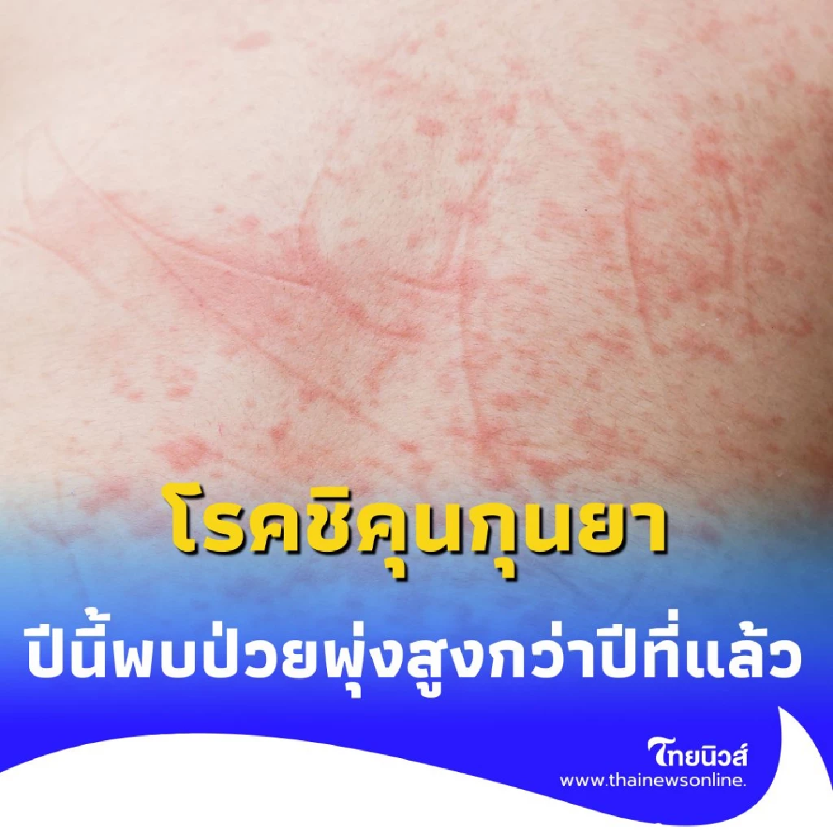 ยอดผู้ป่วย โรคชิคุนกุนยา ปีนี้พุ่งสูงกว่าปีที่แล้วหลายเท่าตัว