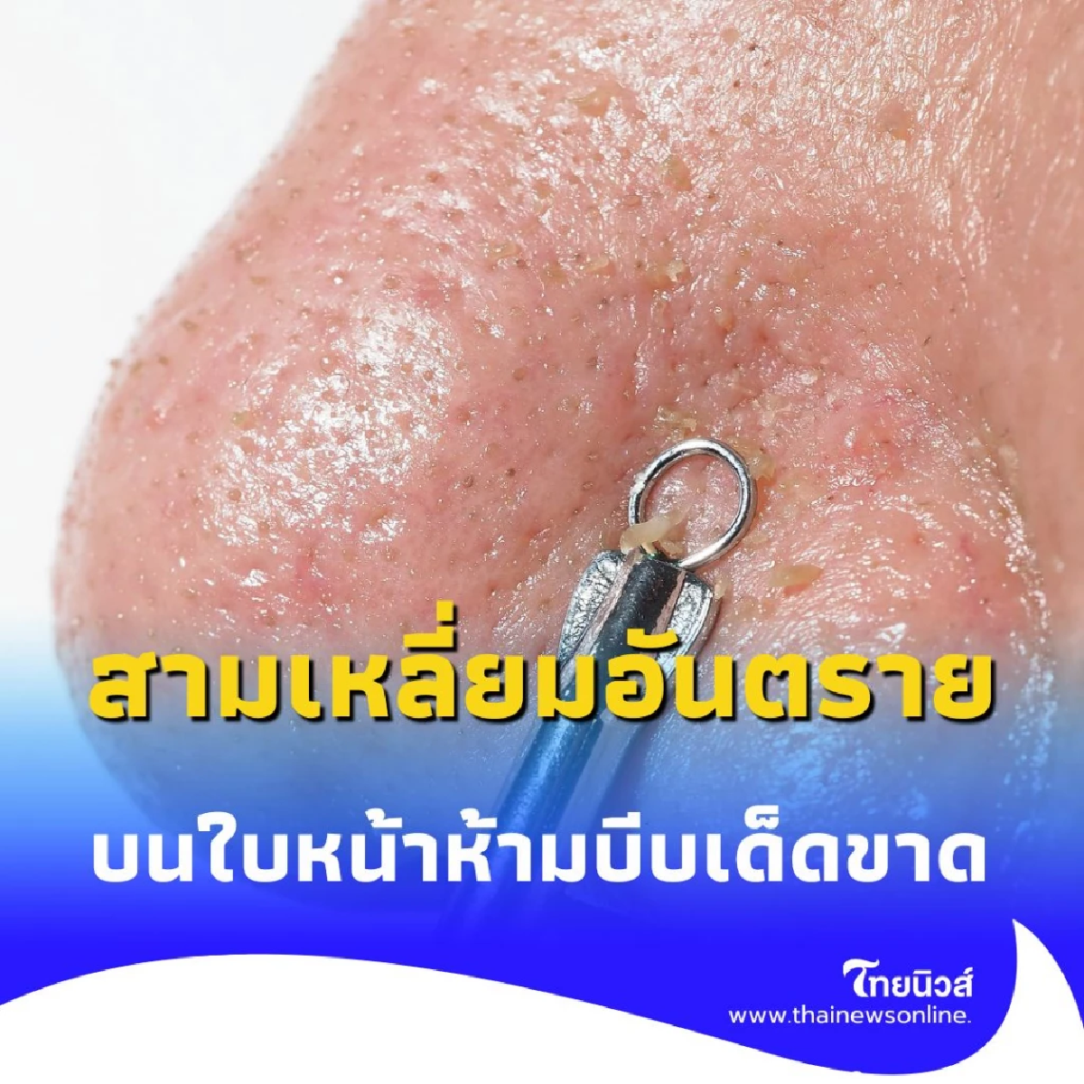 อันตรายกว่าที่คิด บีบสิวใน สามเหลี่ยมอันตราย เสี่ยงติดเชื้อในสมอง-เสียชีวิต