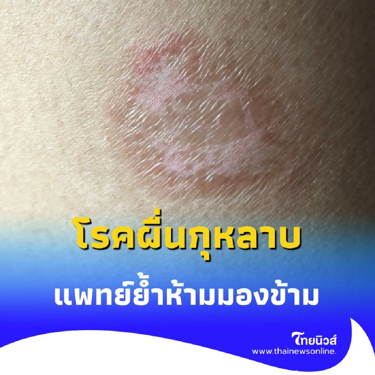 โรคผื่นกุหลาบ เสี่ยงทำให้แท้งบุตร แพทย์ย้ำห้ามมองข้าม