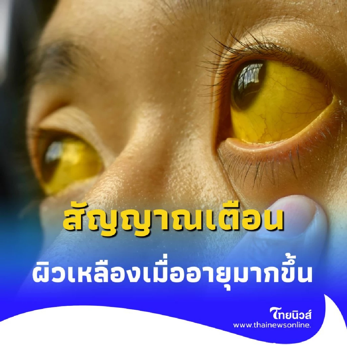 ผิวเหลืองเมื่ออายุมาก ไม่ใช่แค่เรื่องผิว แต่คือสัญญาณจากภายใน
