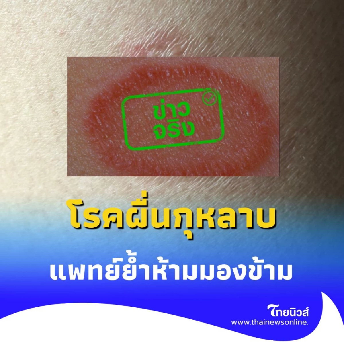 โรคผื่นกุหลาบ เสี่ยงทำให้แท้งบุตร แพทย์ย้ำห้ามมองข้าม