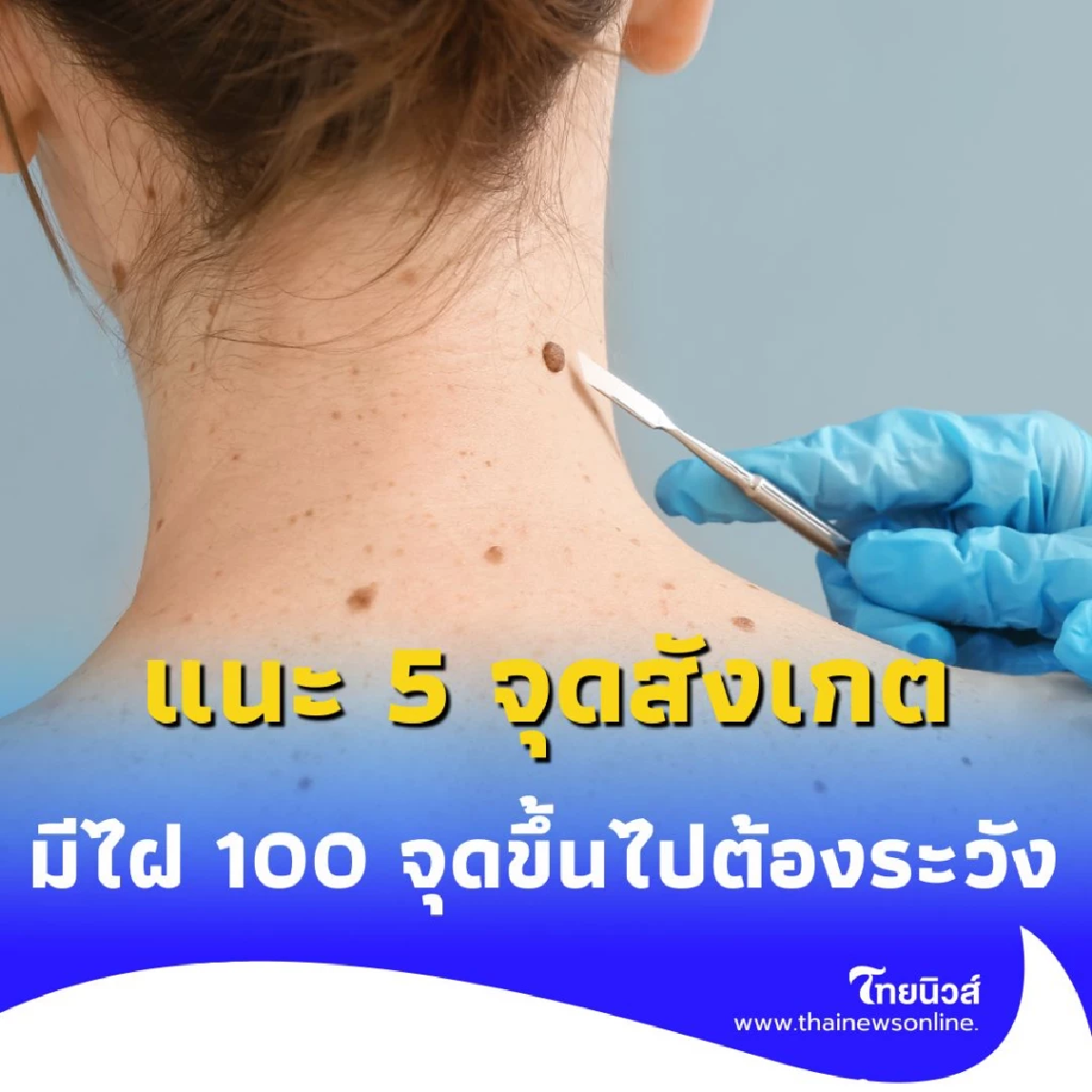 เปิดวิธีเช็กไฝ แนะ 5 จุดสังเกต หากมีไฝ 100 เม็ดขึ้นไป ต้องระวัง