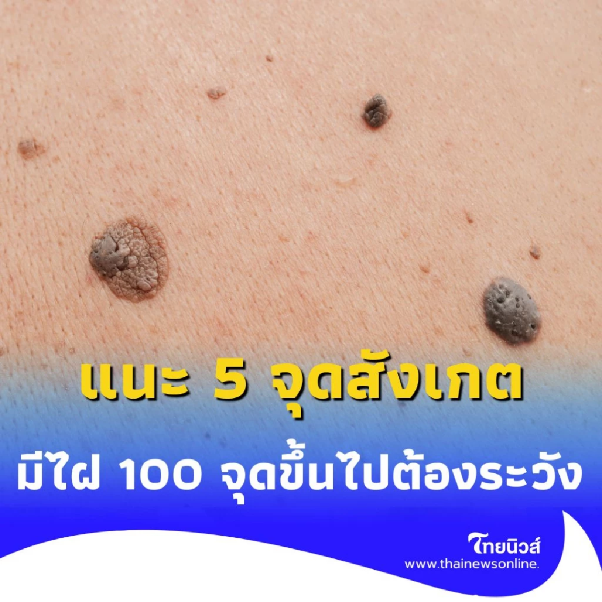 เปิดวิธีเช็กไฝ แนะ 5 จุดสังเกต หากมีไฝ 100 เม็ดขึ้นไป ต้องระวัง