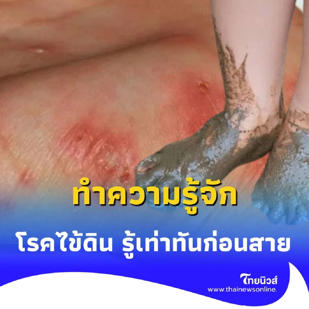 ทำความรู้จัก โรคไข้ดิน พบกำลังระบาดอยู่ รู้ทันก่อนเสี่ยงถึงชีวิต
