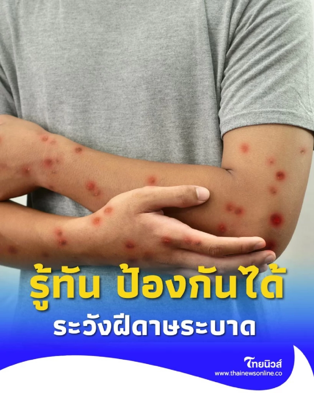 รู้ทัน ป้องกันได้ รับมือฝีดาษวานร หลังพบผู้ป่วยรายใหม่ในไทย