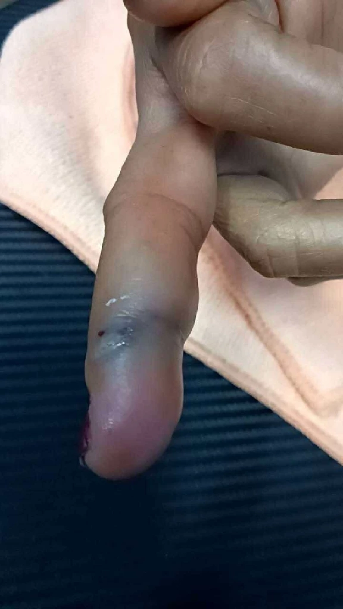 หญิงไปหาหมอ ถูกเปลือกกุ้งทิ่มมือ สุดท้ายเกือบเป็นฝันร้าย