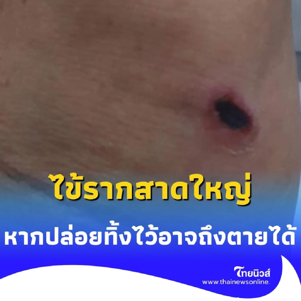 หน้าฝนระวัง อาการแบบนี้ใช่ ไข้รากสาดใหญ่ ไหม หากปล่อยทิ้งไว้อาจถึงตายได้