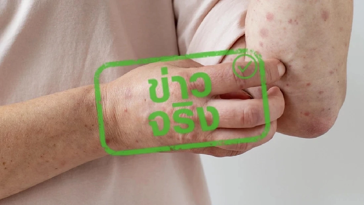 รู้ทัน ป้องกันได้ รับมือฝีดาษวานร หลังพบผู้ป่วยรายใหม่ในไทย