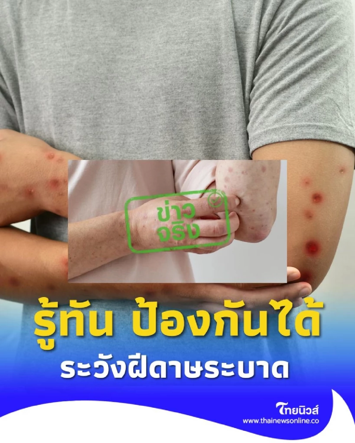 รู้ทัน ป้องกันได้ รับมือฝีดาษวานร หลังพบผู้ป่วยรายใหม่ในไทย