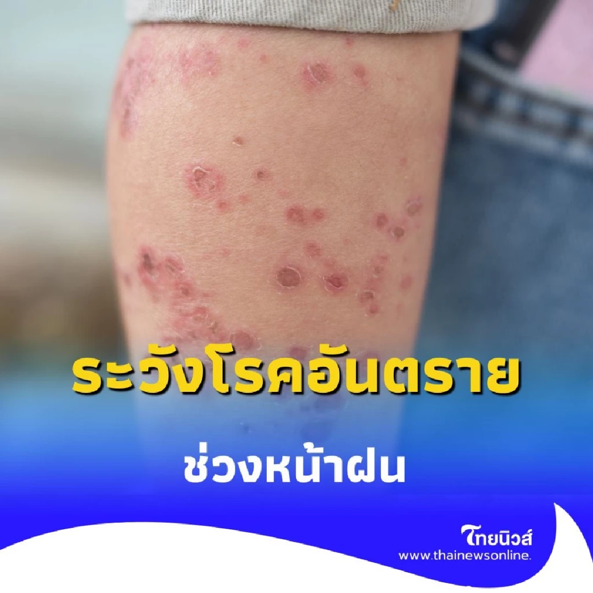 5 โรคอันตรายช่วงหน้าฝน พร้อมวิธีป้องกันง่ายๆ ที่ทุกคนทำได้