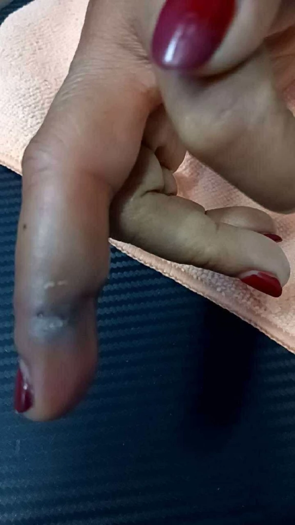 หญิงไปหาหมอ ถูกเปลือกกุ้งทิ่มมือ สุดท้ายเกือบเป็นฝันร้าย