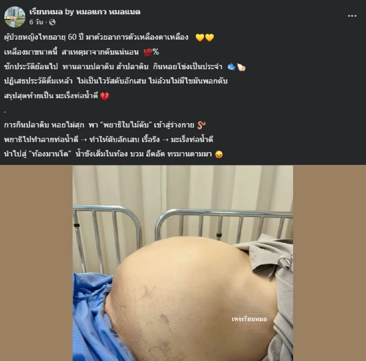 เตือนสายกินดิบ หญิงวัย 60 ท้องมานโต สุดท้ายเป็นมะเร็งท่อน้ำดี