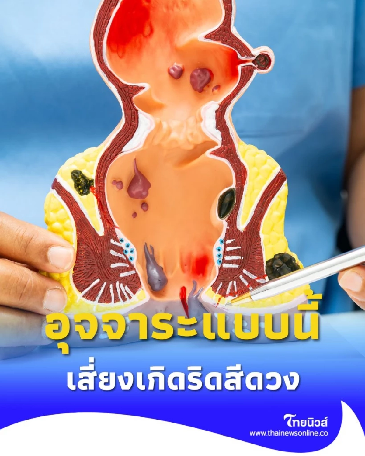 สัญญาณอันตราย อุจจาระแบบนี้ เสี่ยงริดสีดวง และ ลำไส้โป่งพอง