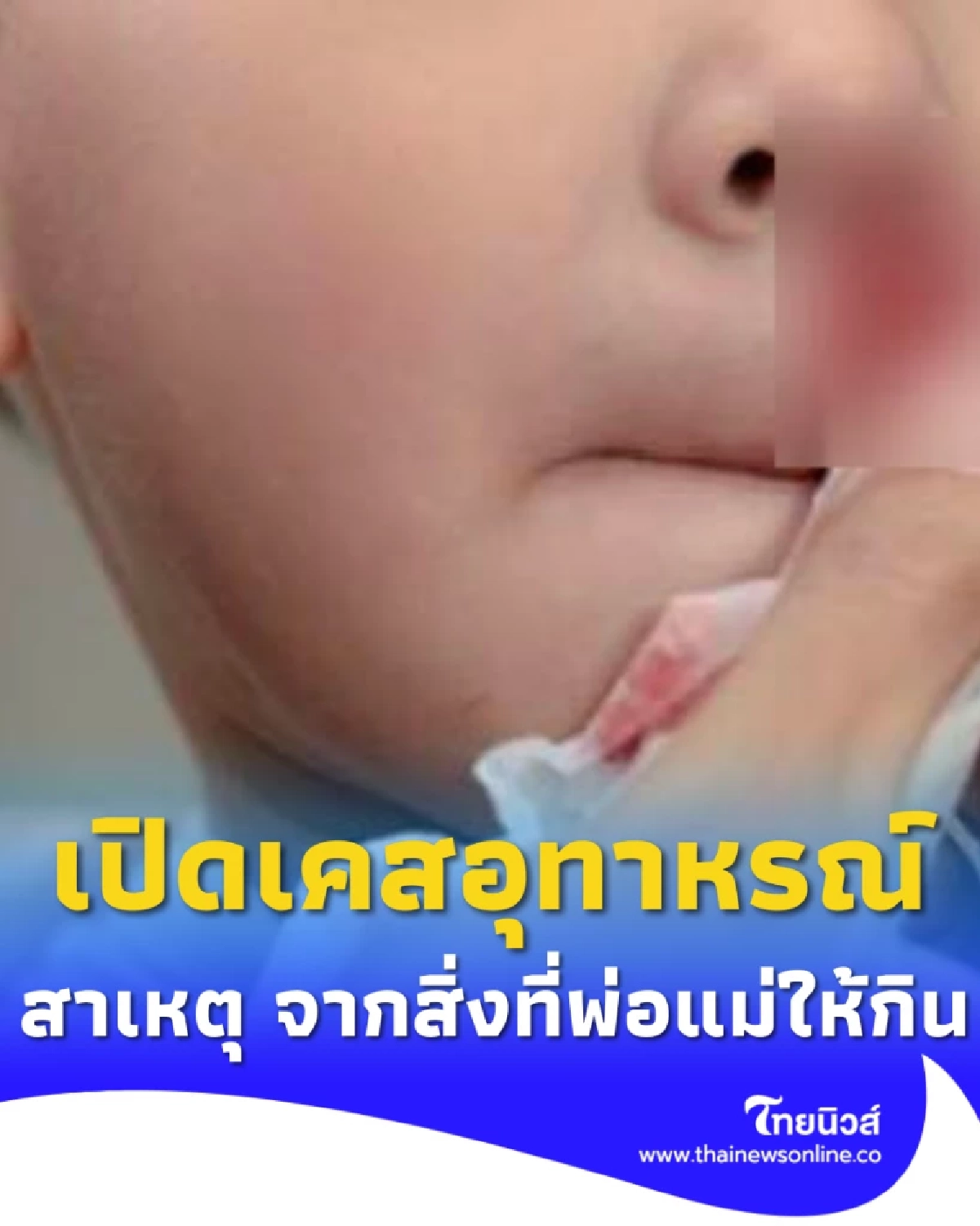เด็ก 7 ขวบเลือดกำเดาไหลไม่หยุด หมอซักลึกเจอสาเหตุจากอาหารเสริม
