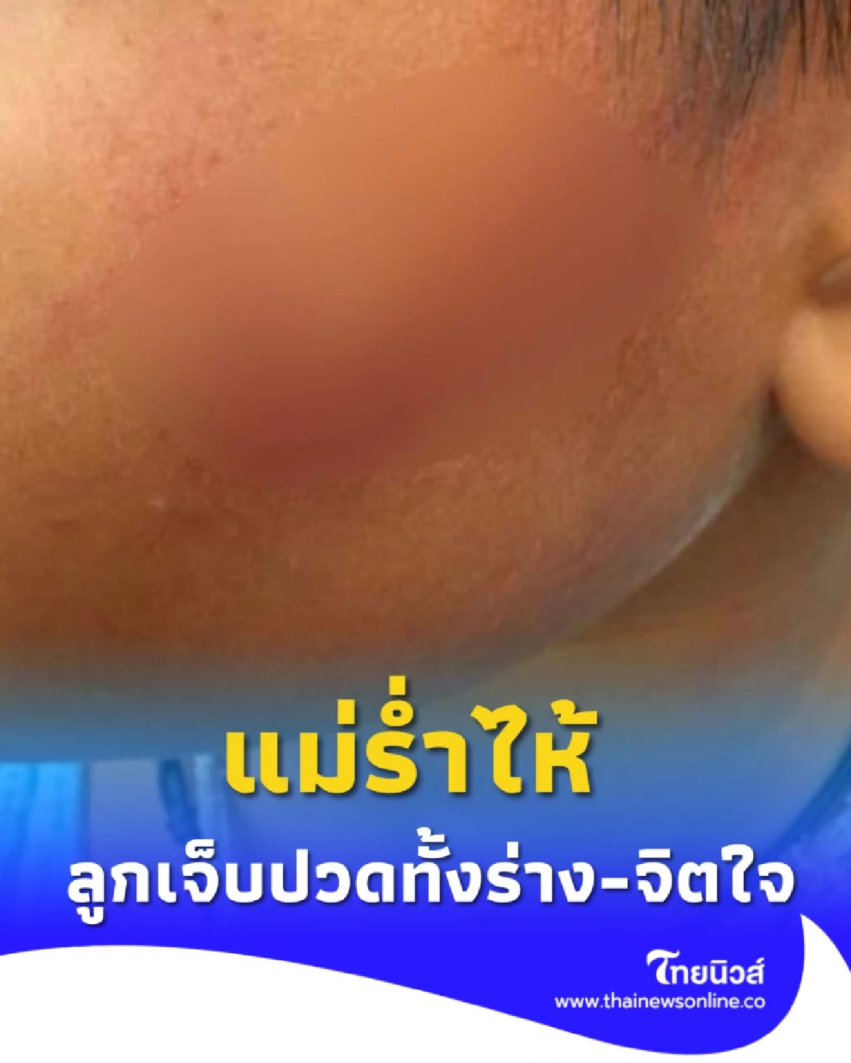แม่สุดช้ำ ขอเพียงอย่างเดียว หลังครูโหดตีลูก 7 ขวบ จนเป็นแผลในใจ