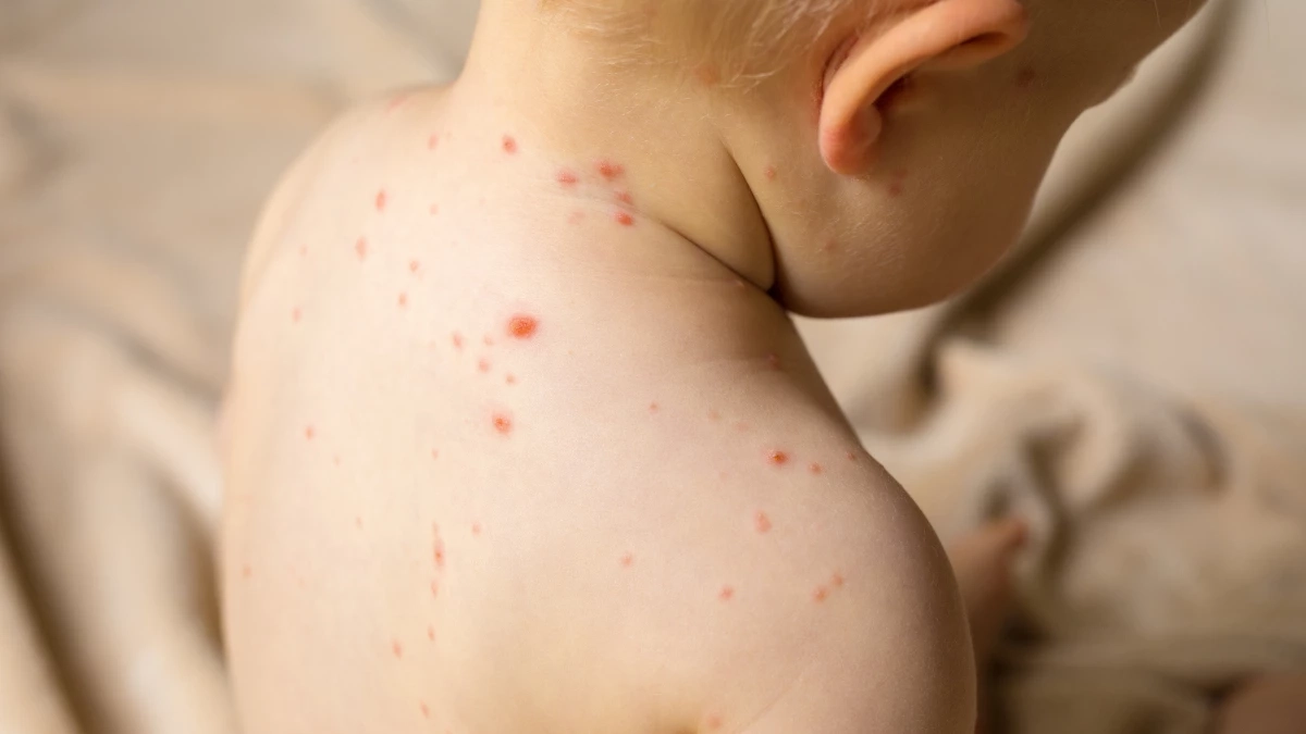 ระวังโรคหัด เชียงรายชายแดนเสี่ยงสูง ปี 68 ป่วยสะสมเกือบ 2,000