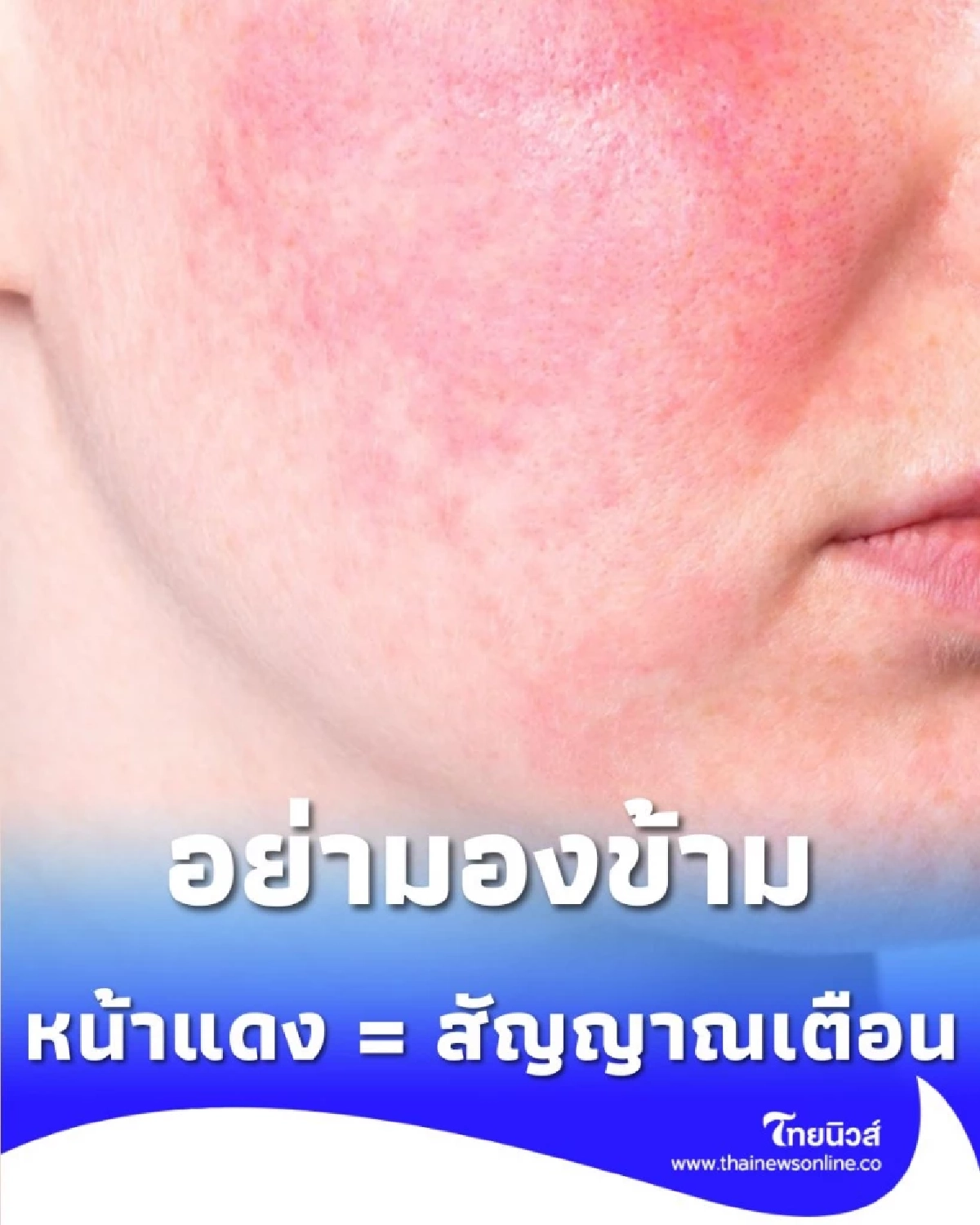 ทำไมเพื่อนเรา หน้าแดงก่ำ แต่เรากลับ หน้าซีด หลังดื่ม ภาวะที่คุณอาจไม่รู้ว่าเสี่ยง