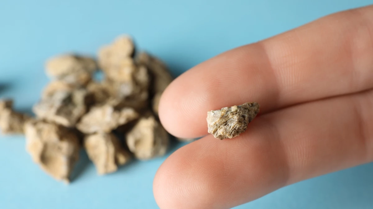 ระวังให้ดี กลุ่มเสี่ยง “นิ่วในถุงน้ำดี” ใกล้ตัวกว่าที่คิด