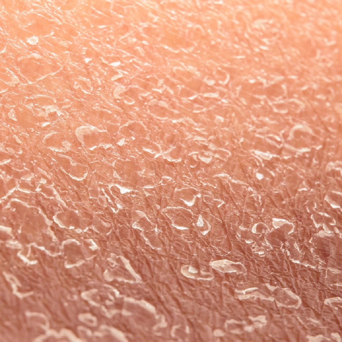 เตือน! 8 วิธีดูแลผิวหน้าหนาว หยุดผิวพังในอากาศแห้งจัด