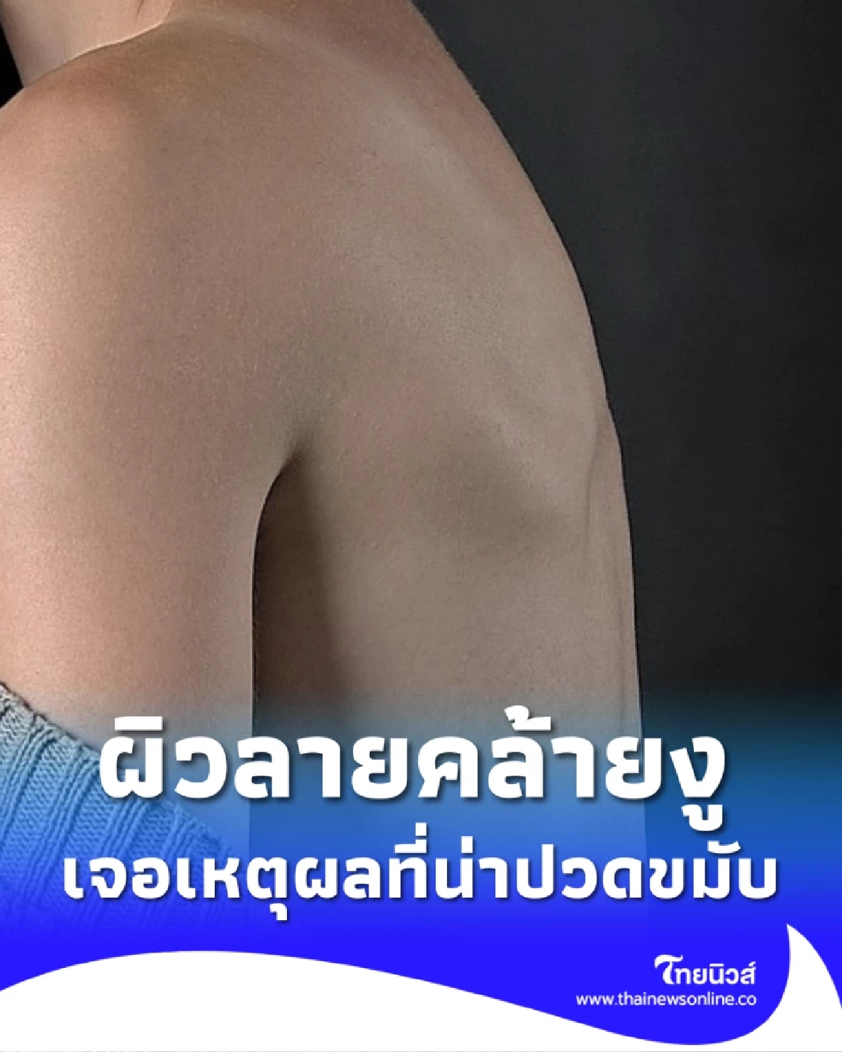 สาววัย 40 จู่ๆ อาการทรุด ถอดเสื้อออกดูเห็นผิวหนังลายคล้ายงู