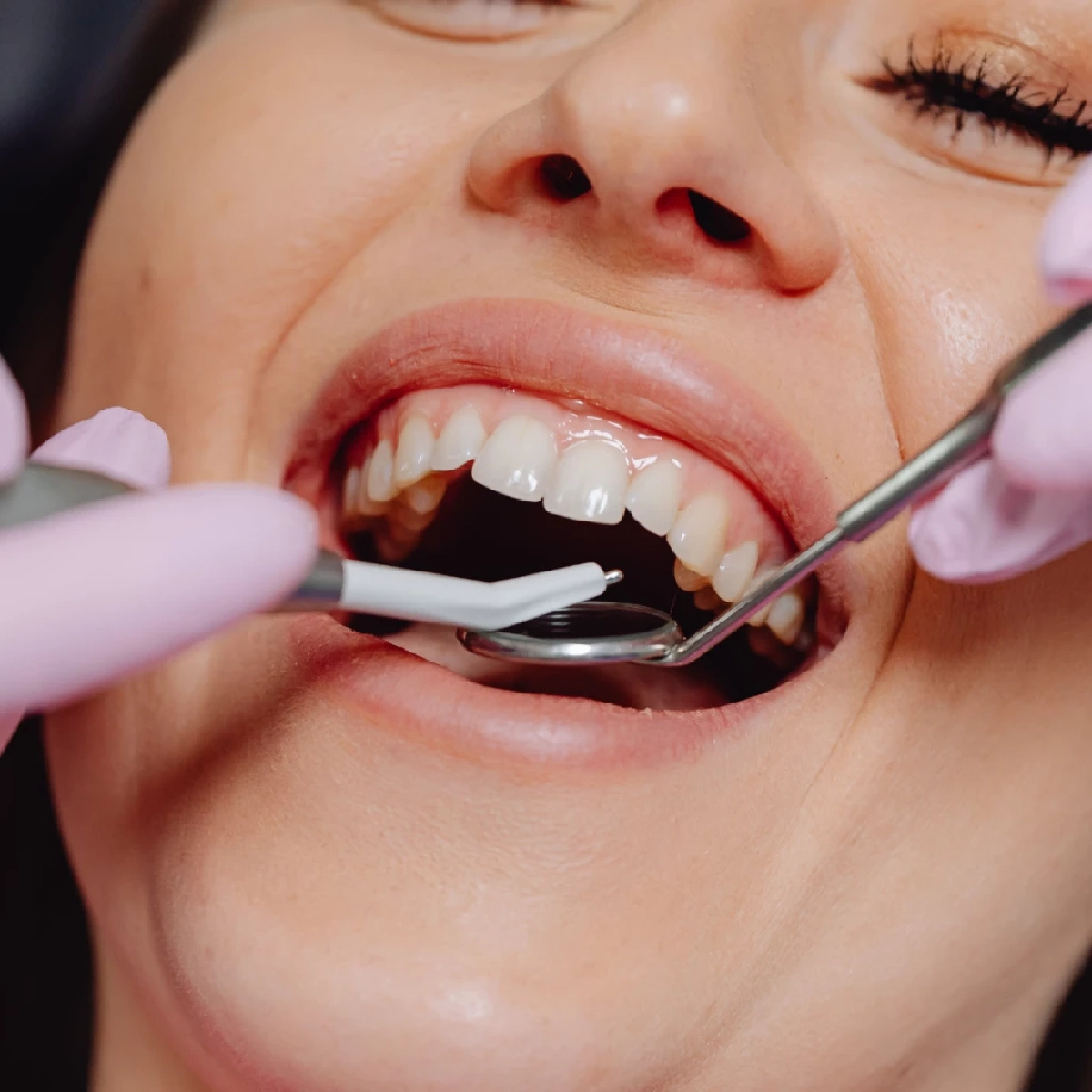 สปส. เตือนผู้ประกันตน ม.33 และ ม.39 รีบใช้สิทธิทำฟัน 900 บาท ก่อนหมดปี 68