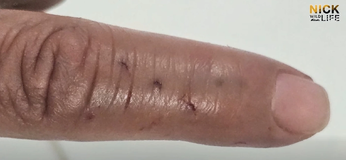 เปิดอาการล่าสุด "นิค อสรพิษวิทยา" หลังถูกจงอาง 3 เมตร กัดเข้าเต็ม ๆ