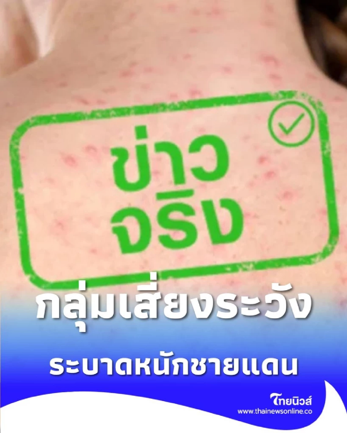 จับตา โรคหัดลาม ระบาดหนักชายแดน กลุ่มเสี่ยงต้องรีบฉีดวัคซีน ก่อนลุกลาม
