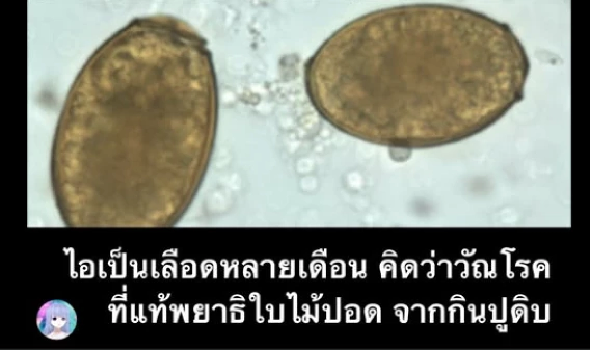 สาว ไอเรื้อรัง 1 ปี นึกว่าฝุ่น pm 2.5 รู้ความจริงตกใจ เกิดจากเมนูโปรด