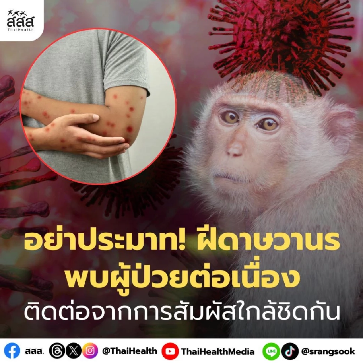 ฝีดาษวานรยังพบผู้ป่วยต่อเนื่อง แม้ยังไม่ระบาดเป็นวงกว้าง