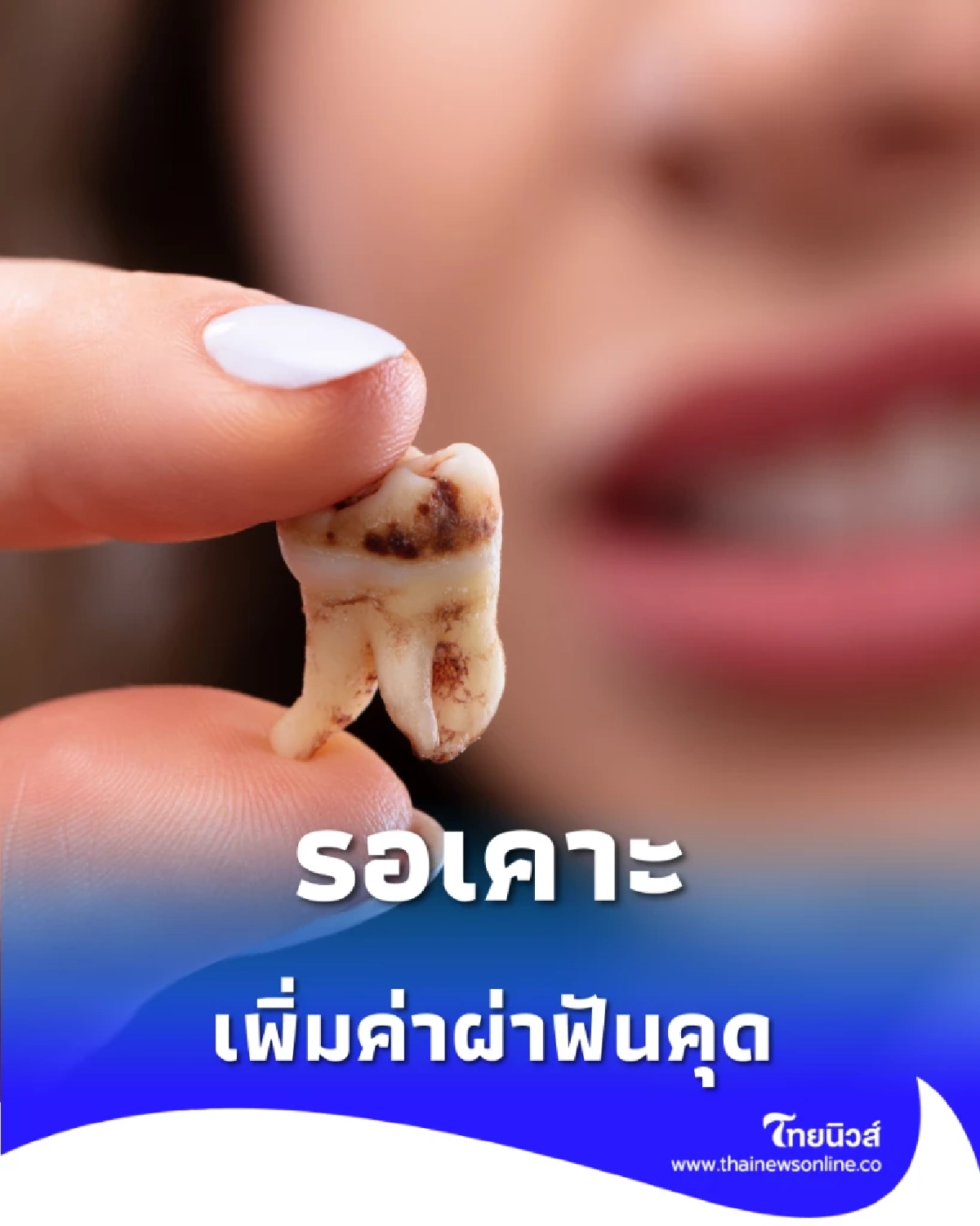 รอบอร์ดแพทย์เคาะ ประกันสังคมจ่อปรับเพิ่ม ค่าผ่าฟันคุด ปี 2569