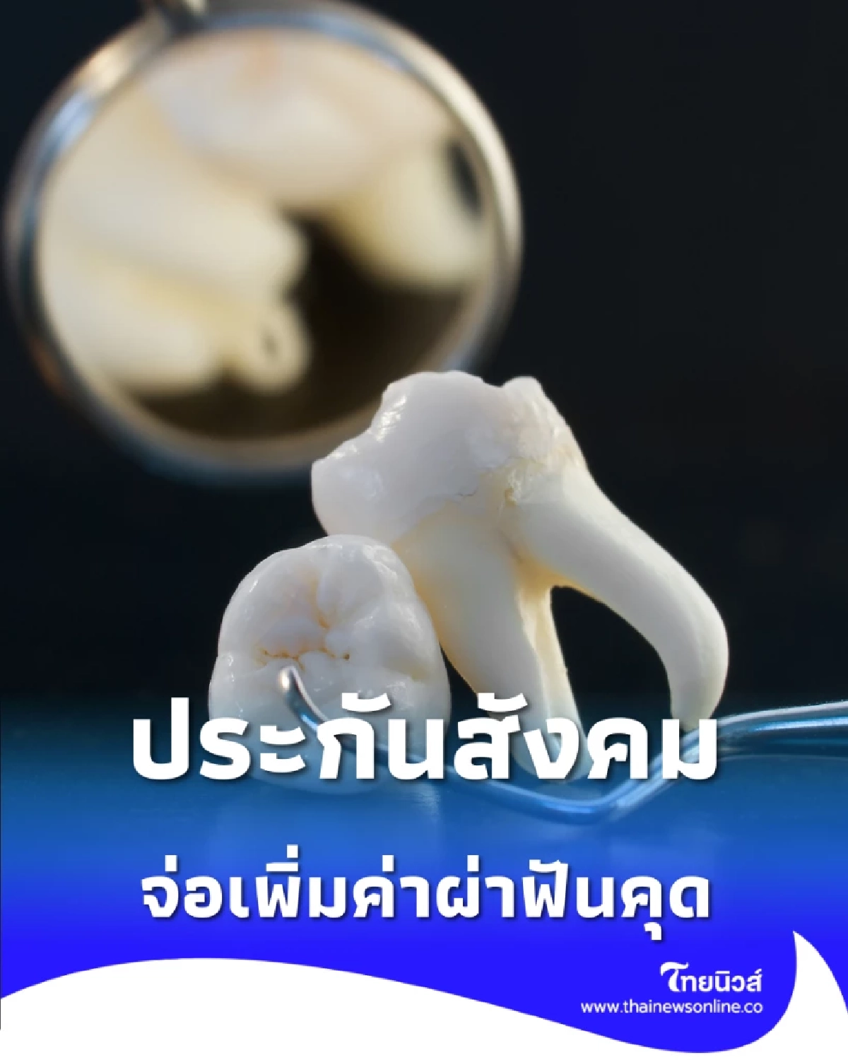 รอบอร์ดแพทย์เคาะ ประกันสังคมจ่อปรับเพิ่ม ค่าผ่าฟันคุด ปี 2569