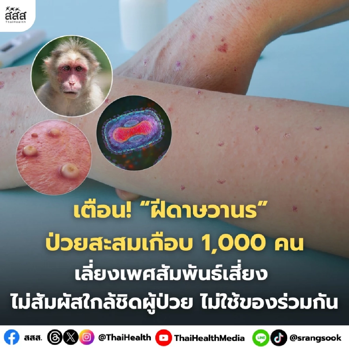 ไทยพบผู้ป่วย "ฝีดาษวานร" สะสมเกือบ 1,000 ราย กระจายหลายจังหวัด