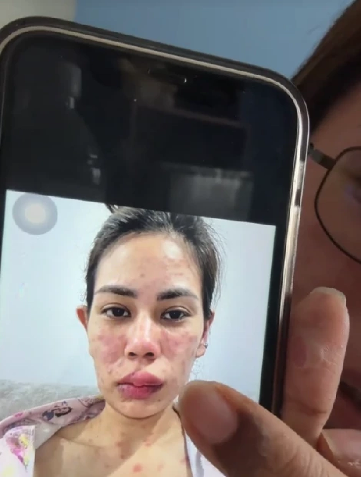 สาวเล่าอุทาหรณ์ ผื่นขึ้นหน้า ก่อนลามทั้งตัว รักษานานเป็นเดือน