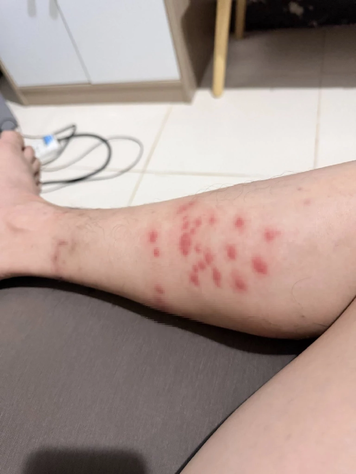 อุทาหรณ์นักวิ่ง เจอ "ตัวคุ่น" เล่นงาน คันทรมานกว่าที่คิด