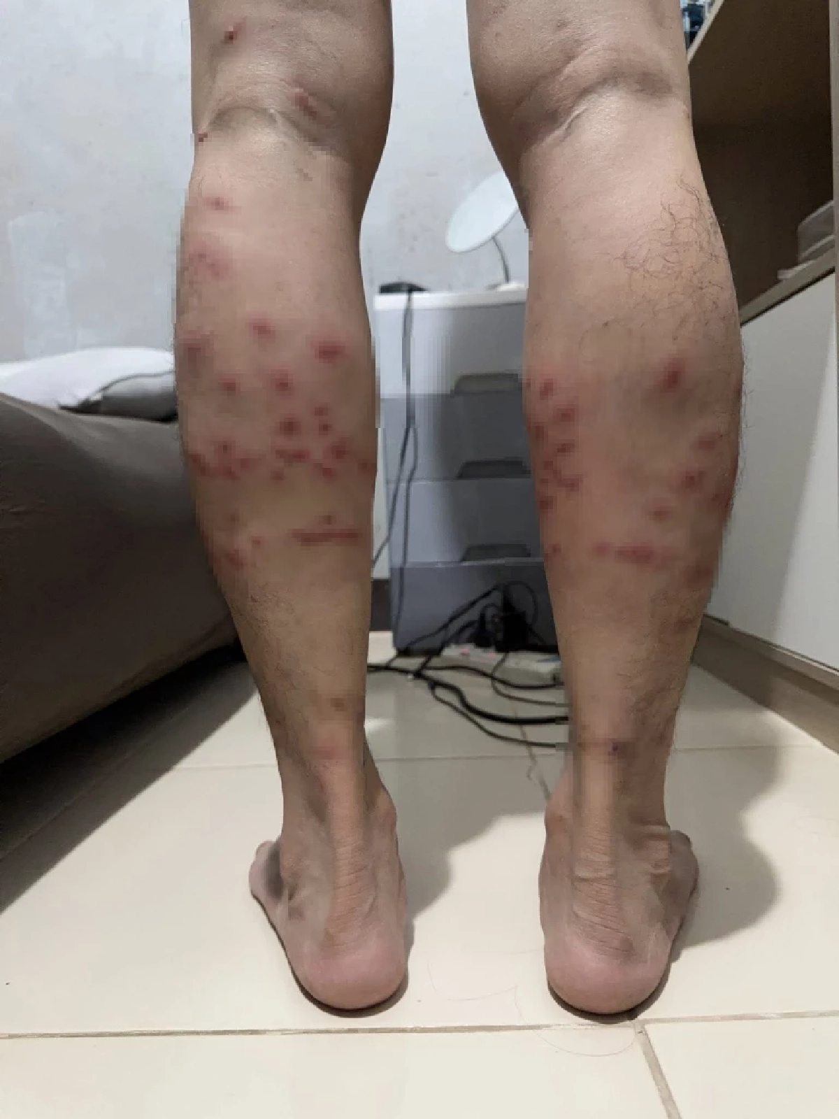 อุทาหรณ์นักวิ่ง เจอ "ตัวคุ่น" เล่นงาน คันทรมานกว่าที่คิด