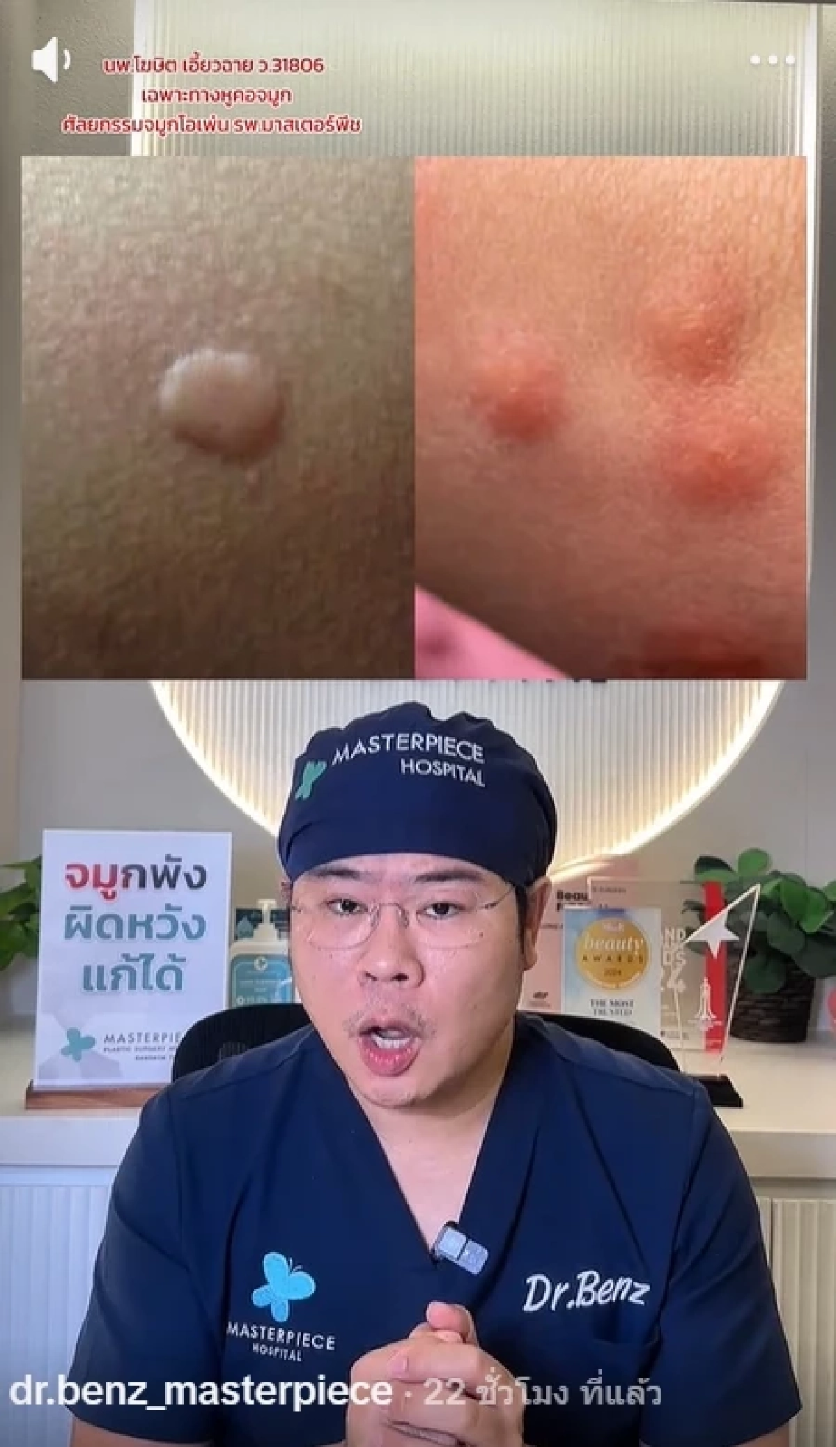 หมอเบนซ์ เตือน แยกให้ออก "ยุงหรือคุ่นกัด" พลาดเกาเสี่ยงติดเชื้อ