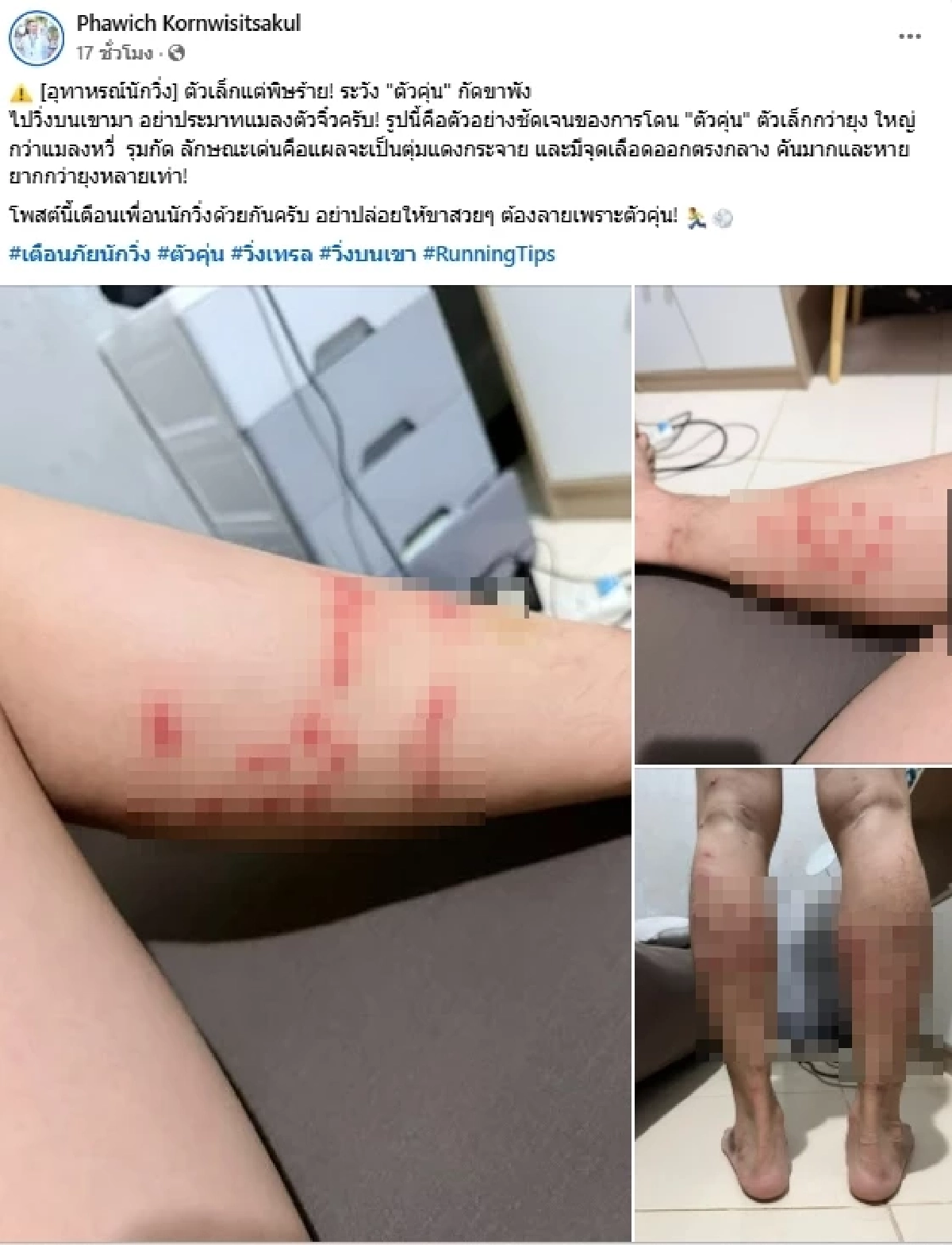 อุทาหรณ์นักวิ่ง เจอ "ตัวคุ่น" เล่นงาน คันทรมานกว่าที่คิด