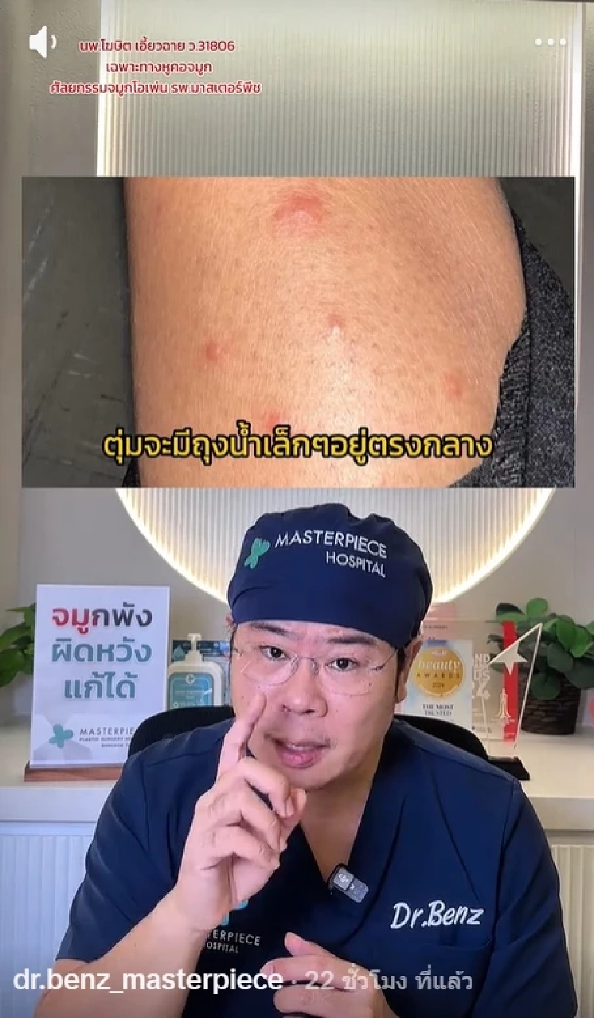 หมอเบนซ์ เตือน แยกให้ออก "ยุงหรือคุ่นกัด" พลาดเกาเสี่ยงติดเชื้อ