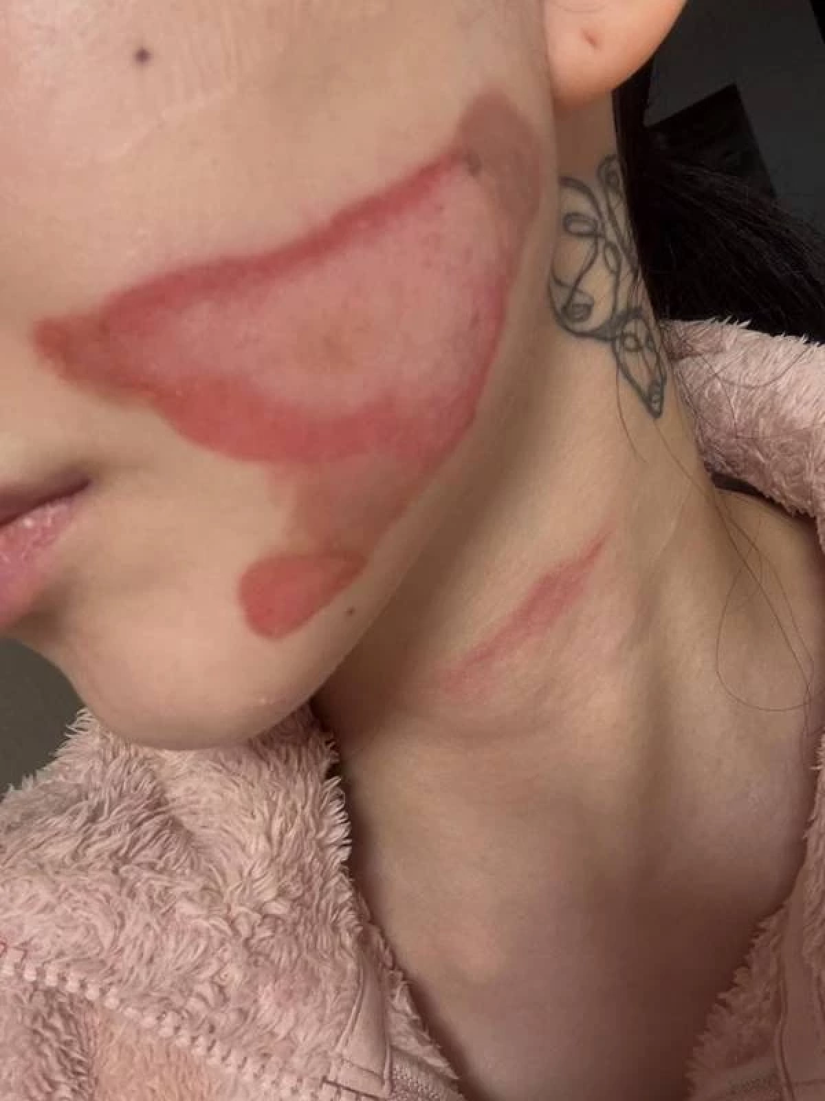 อดีตไอดอลคนดัง หน้าพังไฟไหม้ พีกกว่าคือคำพูดของผู้บริหารคลินิก