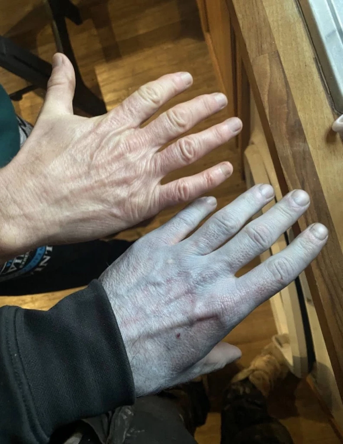 หนุ่มหลับยาว 14 ชม. ตื่นขึ้นตัวกลายเป็นสีฟ้า ผลตรวจออกมาทำตกใจ