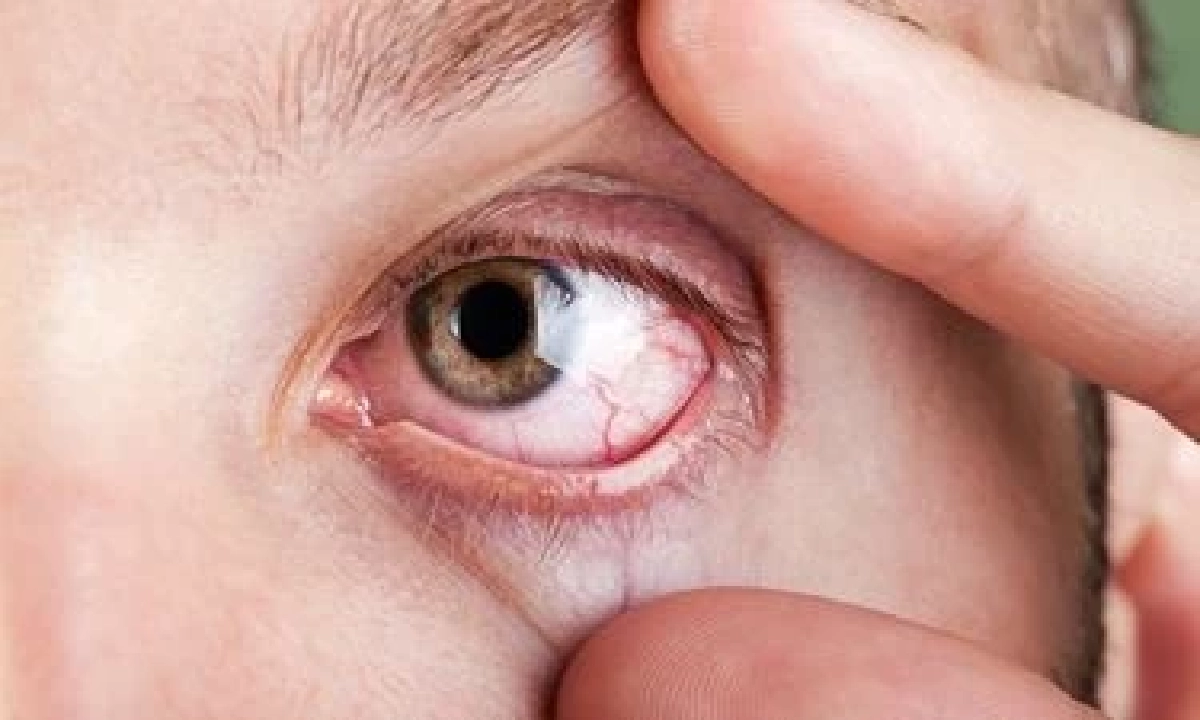 “วุ้นในตาเสื่อม” ภัยเงียบใกล้ตัว เห็นจุดดำลอยไปมา อย่านิ่งนอนใจ