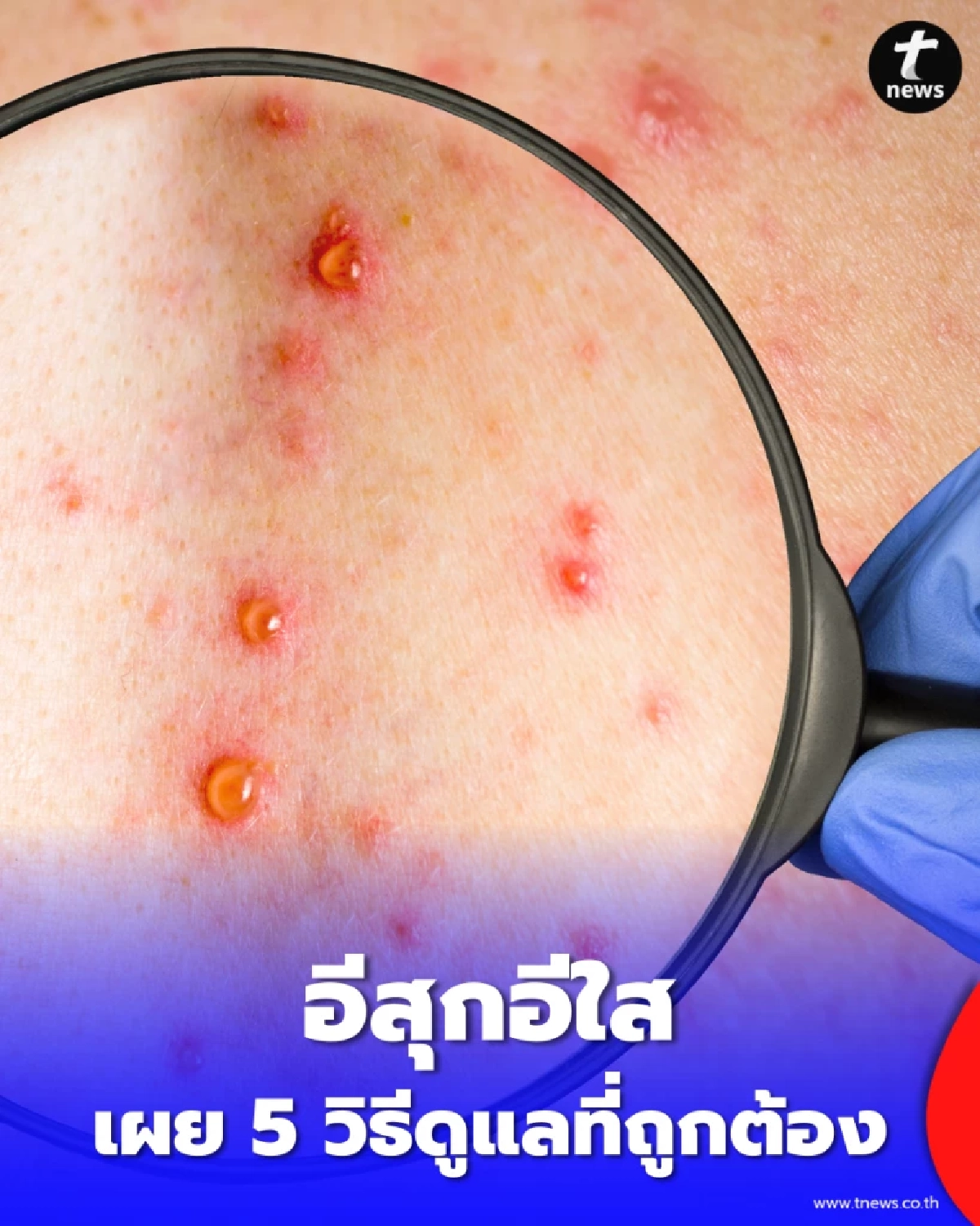 อีสุกอีใสระวังติดเชื้อรุนแรง เผย 5 วิธีดูแลที่ถูกวิธี ห้ามอาบน้ำต้มผัก